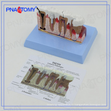 PNT-0528ad modèle de dents dentaires d&#39;ostéoporose éducatif